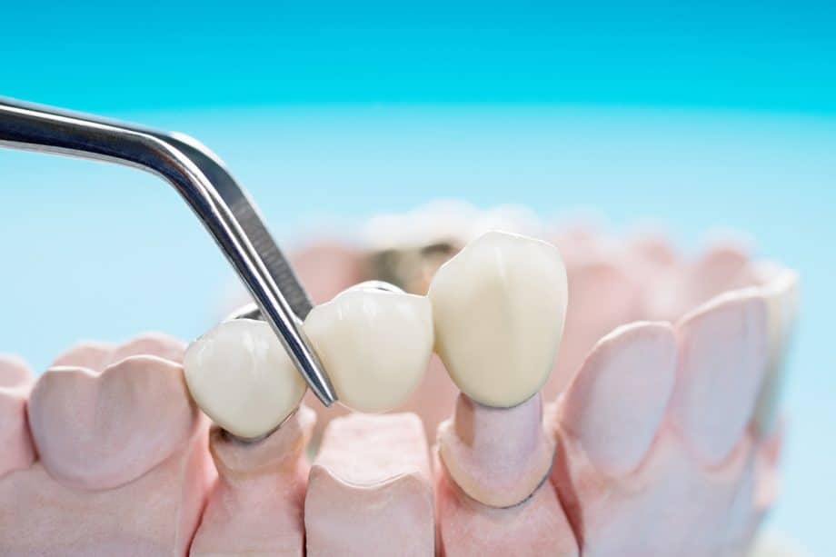 Dental Bridges in Clifton