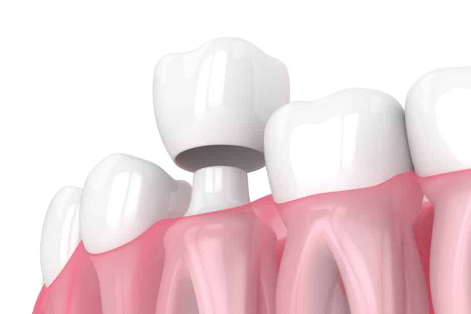 CEREC Same-Day Crowns vs. Traditional Crowns: What’s the Real Difference?