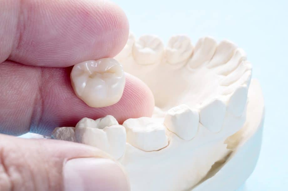 How Long Do Dental Crowns Last?