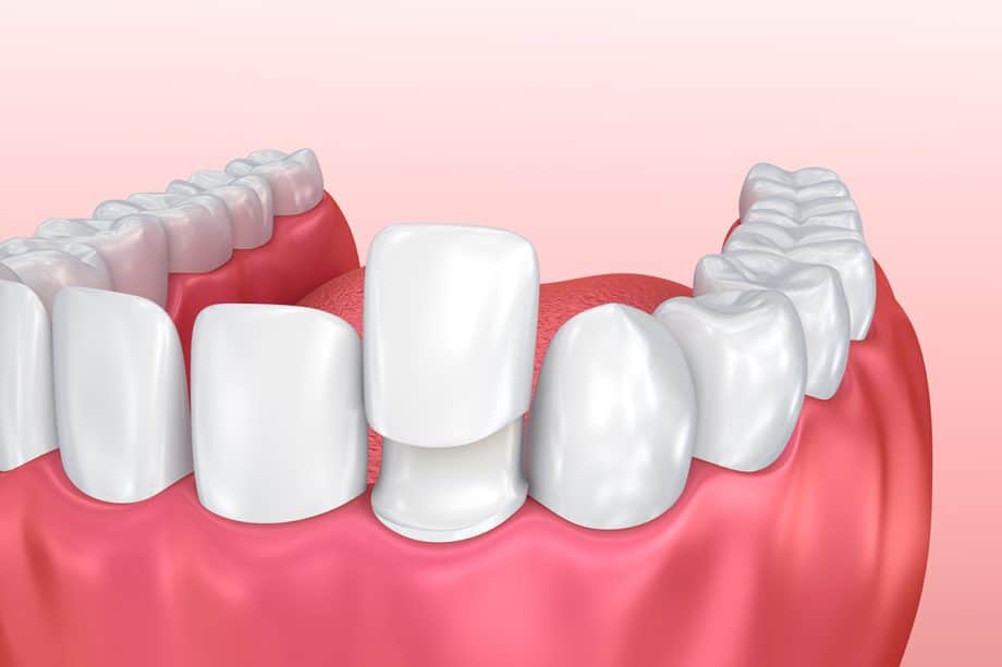 How Veneers Can Fix More Than Just Your Smile